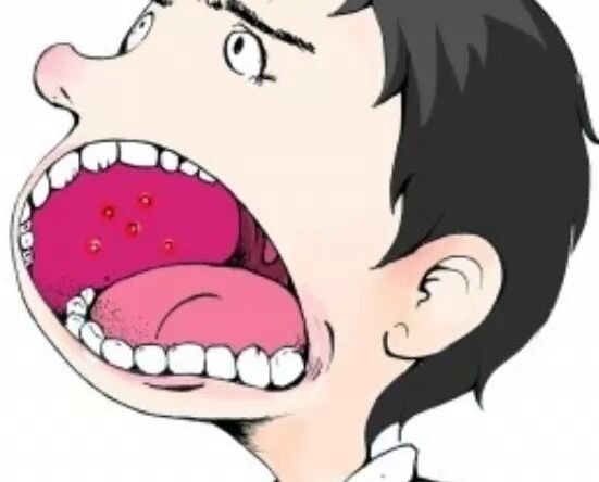 口腔溃疡疼痛怎么办？